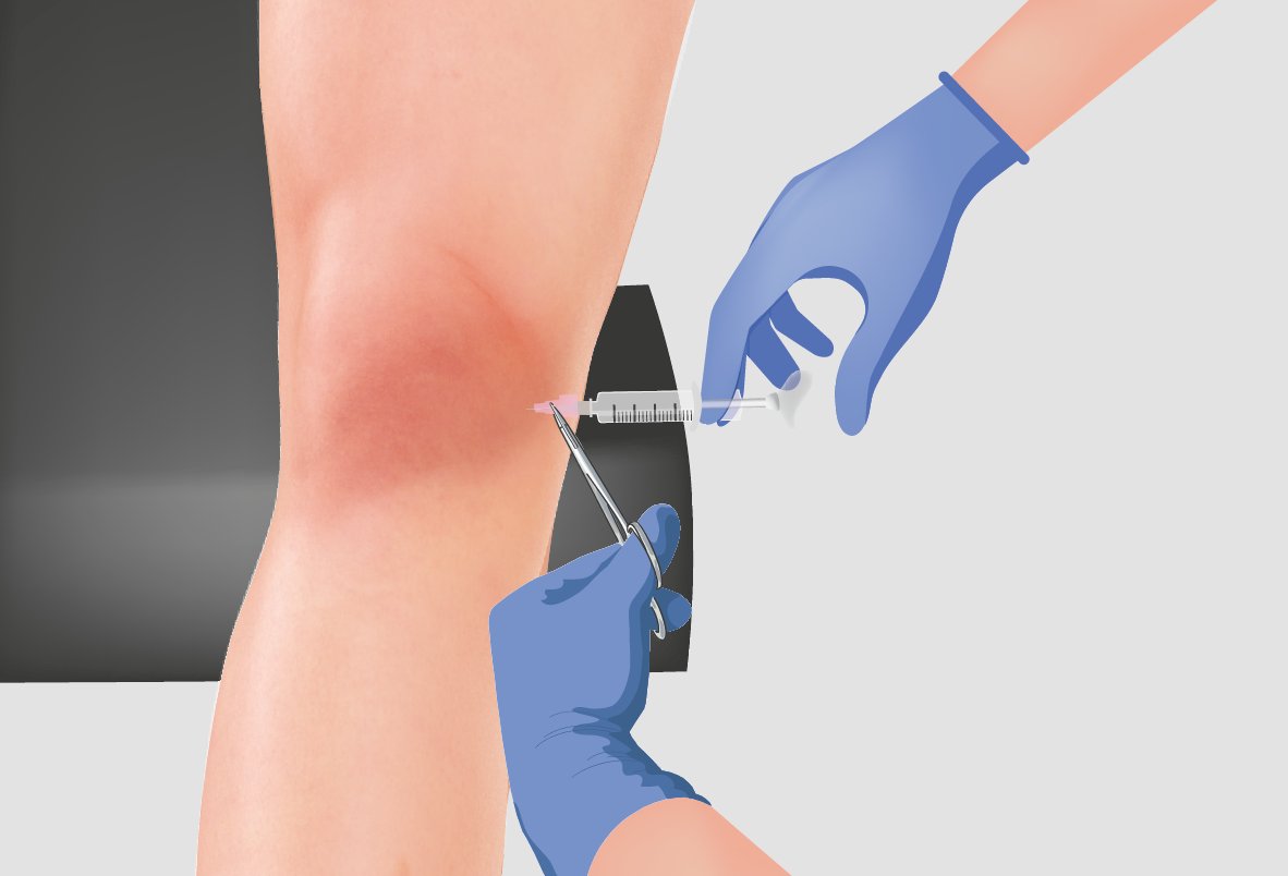 Illustration of an Arthrosamid injection into the knee